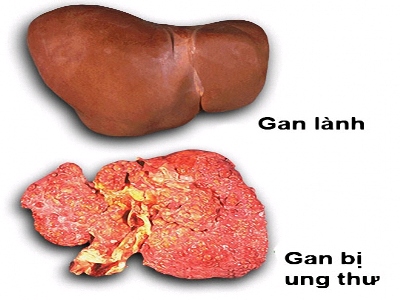 Bệnh ung thư gan có lây không?