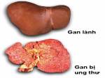 12 dấu hiệu nhận biết ung thư gan
