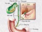 Bài thuốc chữa sỏi mật