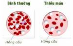 Bài thuốc Trị thiếu máu